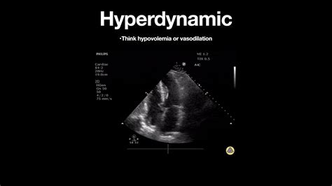 hyperdynamic left ventricular function guidelines.